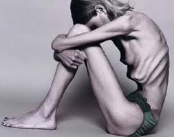 Anorexia Nervosa