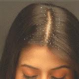 Dandruff Home and Herbal Remedies