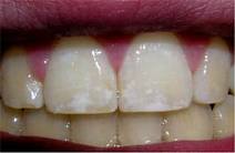 How to Overcome Fluorosis
