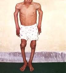 Keshan Disease