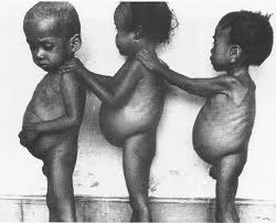 Kwashiorkor Disease