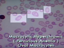 Macrocytic Hypochromic Anemia