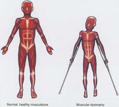 Duchenne Muscular Dystrophy