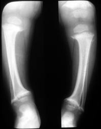 Osteomalacia