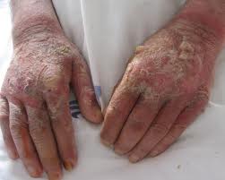 Pellagra