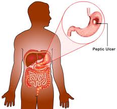 Peptic Ulcer