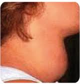 Postpartum Thyroiditis