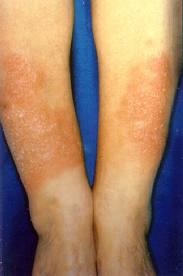 Pretibial Myxedema