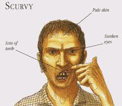 Symptoms of Scurvy