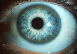Wilson's Disease