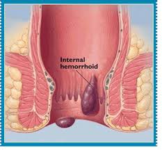 Internal Hemorrhoids