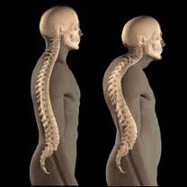 Herbal, Natural, Home Remedies for Osteoporosis